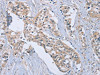 The image on the left is immunohistochemistry of paraffin-embedded Human breast cancer tissue using CSB-PA798103 (EDA Antibody) at dilution 1/40, on the right is treated with synthetic peptide. (Original magnification: ×200)