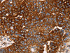 The image on the left is immunohistochemistry of paraffin-embedded Human breast cancer tissue using CSB-PA083210 (EDAR Antibody) at dilution 1/45, on the right is treated with synthetic peptide. (Original magnification: ×200)