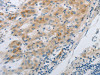 The image on the left is immunohistochemistry of paraffin-embedded Human liver cancer tissue using CSB-PA103567 (GJB6 Antibody) at dilution 1/30, on the right is treated with synthetic peptide. (Original magnification: ×200)