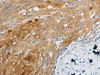 The image on the left is immunohistochemistry of paraffin-embedded Human cervical cancer tissue using CSB-PA937611 (EDNRB Antibody) at dilution 1/30, on the right is treated with synthetic peptide. (Original magnification: ×200)