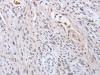 The image on the left is immunohistochemistry of paraffin-embedded Human esophagus cancer tissue using CSB-PA063009 (SFRP1 Antibody) at dilution 1/15, on the right is treated with synthetic peptide. (Original magnification: ×200)