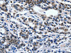 The image on the left is immunohistochemistry of paraffin-embedded Human gastic cancer tissue using CSB-PA575380 (ENPP3 Antibody) at dilution 1/80, on the right is treated with synthetic peptide. (Original magnification: ×200)