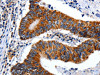 The image on the left is immunohistochemistry of paraffin-embedded Human colon cancer tissue using CSB-PA448237 (ENPP3 Antibody) at dilution 1/15, on the right is treated with synthetic peptide. (Original magnification: ×200)