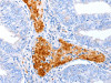 The image on the left is immunohistochemistry of paraffin-embedded Human cervical cancer tissue using CSB-PA117174 (ENPP7 Antibody) at dilution 1/50, on the right is treated with synthetic peptide. (Original magnification: ×200)