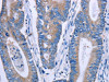 The image on the left is immunohistochemistry of paraffin-embedded Human colon cancer tissue using CSB-PA994398 (ENPP7 Antibody) at dilution 1/40, on the right is treated with synthetic peptide. (Original magnification: ×200)