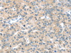 The image on the left is immunohistochemistry of paraffin-embedded Human liver cancer tissue using CSB-PA179150 (EPHA2 Antibody) at dilution 1/20, on the right is treated with synthetic peptide. (Original magnification: ×200)