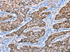 The image on the left is immunohistochemistry of paraffin-embedded Human esophagus cancer tissue using CSB-PA830643 (EPHA4 Antibody) at dilution 1/15, on the right is treated with synthetic peptide. (Original magnification: ×200)