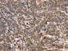 The image on the left is immunohistochemistry of paraffin-embedded Human liver cancer tissue using CSB-PA980670 (EPOR Antibody) at dilution 1/40, on the right is treated with synthetic peptide. (Original magnification: ×200)