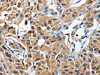 The image on the left is immunohistochemistry of paraffin-embedded Human lung cancer tissue using CSB-PA132342 (DUSP8 Antibody) at dilution 1/40, on the right is treated with synthetic peptide. (Original magnification: ×200)