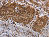 The image on the left is immunohistochemistry of paraffin-embedded Human cervical cancer tissue using CSB-PA953662 (DUSP8 Antibody) at dilution 1/30, on the right is treated with synthetic peptide. (Original magnification: ×200)