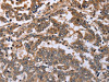 The image on the left is immunohistochemistry of paraffin-embedded Human liver cancer tissue using CSB-PA694254 (FAF1 Antibody) at dilution 1/40, on the right is treated with synthetic peptide. (Original magnification: ×200)