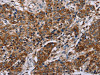 The image on the left is immunohistochemistry of paraffin-embedded Human liver cancer tissue using CSB-PA993404 (FAF1 Antibody) at dilution 1/50, on the right is treated with synthetic peptide. (Original magnification: ×200)