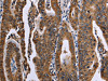 The image on the left is immunohistochemistry of paraffin-embedded Human gastric cancer tissue using CSB-PA993404 (FAF1 Antibody) at dilution 1/50, on the right is treated with synthetic peptide. (Original magnification: ×200)