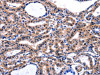 The image on the left is immunohistochemistry of paraffin-embedded Human thyroid cancer tissue using CSB-PA107393 (FBN1 Antibody) at dilution 1/47, on the right is treated with synthetic peptide. (Original magnification: ×200)