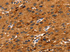 The image on the left is immunohistochemistry of paraffin-embedded Human liver cancer tissue using CSB-PA114336 (FGFR3 Antibody) at dilution 1/30, on the right is treated with synthetic peptide. (Original magnification: ×200)