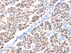 The image on the left is immunohistochemistry of paraffin-embedded Human breast cancer tissue using CSB-PA781017 (FBLN1 Antibody) at dilution 1/12, on the right is treated with synthetic peptide. (Original magnification: ×200)