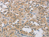 The image on the left is immunohistochemistry of paraffin-embedded Human thyroid cancer tissue using CSB-PA960251 (FOSB Antibody) at dilution 1/20, on the right is treated with synthetic peptide. (Original magnification: ×200)