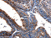 The image on the left is immunohistochemistry of paraffin-embedded Human cervical cancer tissue using CSB-PA594474 (FPR2 Antibody) at dilution 1/17, on the right is treated with synthetic peptide. (Original magnification: ×200)