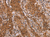The image on the left is immunohistochemistry of paraffin-embedded Human gastric cancer tissue using CSB-PA569524 (FOSL1 Antibody) at dilution 1/30, on the right is treated with synthetic peptide. (Original magnification: ×200)