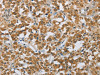 The image on the left is immunohistochemistry of paraffin-embedded Human thyroid cancer tissue using CSB-PA652205 (FOXF1 Antibody) at dilution 1/25, on the right is treated with synthetic peptide. (Original magnification: ×200)