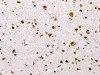 The image on the left is immunohistochemistry of paraffin-embedded Human brain tissue using CSB-PA695081 (TBX2 Antibody) at dilution 1/32, on the right is treated with synthetic peptide. (Original magnification: ×200)