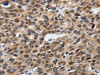 The image on the left is immunohistochemistry of paraffin-embedded Human ovarian cancer tissue using CSB-PA314476 (SUMO1 Antibody) at dilution 1/20, on the right is treated with synthetic peptide. (Original magnification: ×200)
