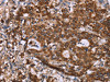 The image on the left is immunohistochemistry of paraffin-embedded Human gastic cancer tissue using CSB-PA102201 (GAD1 Antibody) at dilution 1/40, on the right is treated with synthetic peptide. (Original magnification: ×200)