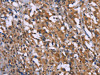 The image on the left is immunohistochemistry of paraffin-embedded Human thyroid cancer tissue using CSB-PA102201 (GAD1 Antibody) at dilution 1/40, on the right is treated with synthetic peptide. (Original magnification: ×200)