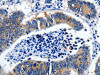 The image on the left is immunohistochemistry of paraffin-embedded Human colon cancer tissue using CSB-PA997765 (GAD2 Antibody) at dilution 1/30, on the right is treated with synthetic peptide. (Original magnification: ×200)