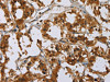 The image on the left is immunohistochemistry of paraffin-embedded Human thyroid cancer tissue using CSB-PA944675 (GATA5 Antibody) at dilution 1/50, on the right is treated with synthetic peptide. (Original magnification: ×200)