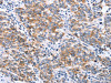 The image on the left is immunohistochemistry of paraffin-embedded Human breast cancer tissue using CSB-PA561954 (CLDN3 Antibody) at dilution 1/25, on the right is treated with synthetic peptide. (Original magnification: ×200) The image on the left is immunohistochemistry of paraffin-embedded Human breast cancer tissue using CSB-PA561954 (CLDN3 Antibody) at dilution 1/25, on the right is treated with synthetic peptide. (Original magnification: ×200)