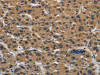 The image on the left is immunohistochemistry of paraffin-embedded Human liver cancer tissue using CSB-PA979246 (CLDN2 Antibody) at dilution 1/50, on the right is treated with synthetic peptide. (Original magnification: ×200)