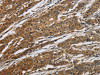 The image on the left is immunohistochemistry of paraffin-embedded Human gastric cancer tissue using CSB-PA979246 (CLDN2 Antibody) at dilution 1/50, on the right is treated with synthetic peptide. (Original magnification: ×200)