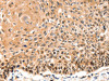 The image on the left is immunohistochemistry of paraffin-embedded Human cervical cancer tissue using CSB-PA778945 (GAS6 Antibody) at dilution 1/10, on the right is treated with synthetic peptide. (Original magnification: ×200)