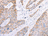 The image on the left is immunohistochemistry of paraffin-embedded Human esophagus cancer tissue using CSB-PA198099 (GFRA3 Antibody) at dilution 1/60, on the right is treated with synthetic peptide. (Original magnification: ×200)