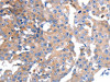 The image on the left is immunohistochemistry of paraffin-embedded Human breast cancer tissue using CSB-PA160122 (GCG Antibody) at dilution 1/15, on the right is treated with synthetic peptide. (Original magnification: ×200)
