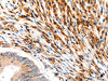 The image on the left is immunohistochemistry of paraffin-embedded Human colon cancer tissue using CSB-PA256733 (SLC2A5 Antibody) at dilution 1/12, on the right is treated with synthetic peptide. (Original magnification: ×200)