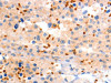 The image on the left is immunohistochemistry of paraffin-embedded Human ovarian cancer tissue using CSB-PA996488 (GRM8 Antibody) at dilution 1/120, on the right is treated with synthetic peptide. (Original magnification: ×200)