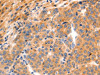 The image on the left is immunohistochemistry of paraffin-embedded Human liver cancer tissue using CSB-PA983109 (GRM8 Antibody) at dilution 1/150, on the right is treated with synthetic peptide. (Original magnification: ×200)