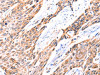 The image on the left is immunohistochemistry of paraffin-embedded Human esophagus cancer tissue using CSB-PA823966 (GNRHR Antibody) at dilution 1/117, on the right is treated with synthetic peptide. (Original magnification: ×200)