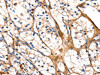 The image on the left is immunohistochemistry of paraffin-embedded Human renal cancer tissue using CSB-PA932427 (GSK3A Antibody) at dilution 1/50, on the right is treated with synthetic peptide. (Original magnification: ×200)