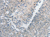 The image on the left is immunohistochemistry of paraffin-embedded Human breast cancer tissue using CSB-PA964562 (GCH1 Antibody) at dilution 1/15, on the right is treated with synthetic peptide. (Original magnification: ×200)