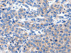 The image on the left is immunohistochemistry of paraffin-embedded Human liver cancer tissue using CSB-PA945160 (KCNH8 Antibody) at dilution 1/15, on the right is treated with synthetic peptide. (Original magnification: ×200)