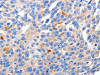 The image on the left is immunohistochemistry of paraffin-embedded Human liver cancer tissue using CSB-PA187759 (KCNH8 Antibody) at dilution 1/50, on the right is treated with synthetic peptide. (Original magnification: ×200)