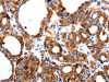 The image on the left is immunohistochemistry of paraffin-embedded Human thyroid cancer tissue using CSB-PA202569 (HCN1 Antibody) at dilution 1/80, on the right is treated with synthetic peptide. (Original magnification: ×200)