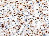The image on the left is immunohistochemistry of paraffin-embedded Human lung cancer tissue using CSB-PA278920 (HDAC1 Antibody) at dilution 1/20, on the right is treated with synthetic peptide. (Original magnification: ×200)