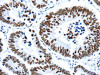 The image on the left is immunohistochemistry of paraffin-embedded Human colon cancer tissue using CSB-PA017043 (HDAC2 Antibody) at dilution 1/17, on the right is treated with synthetic peptide. (Original magnification: ×200)