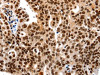 The image on the left is immunohistochemistry of paraffin-embedded Human ovarian cancer tissue using CSB-PA260045 (HDAC2 Antibody) at dilution 1/25, on the right is treated with synthetic peptide. (Original magnification: ×200)