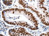 The image on the left is immunohistochemistry of paraffin-embedded Human colon cancer tissue using CSB-PA260045 (HDAC2 Antibody) at dilution 1/25, on the right is treated with synthetic peptide. (Original magnification: ×200)