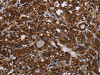 The image on the left is immunohistochemistry of paraffin-embedded Human thyroid cancer tissue using CSB-PA066115 (HDAC7 Antibody) at dilution 1/20, on the right is treated with synthetic peptide. (Original magnification: ×200)